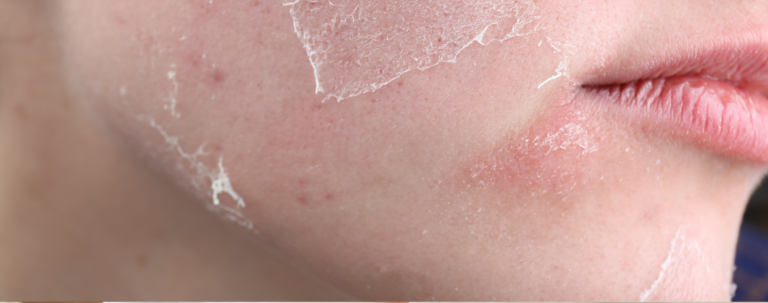 Skóra wygląda gorzej po poprawie pielęgnacji? To nie regres, tylko faza przejściowa